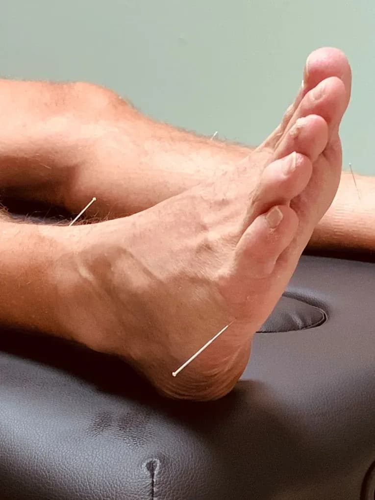 Behandelaar die de werkwijze van acupunctuur toepast